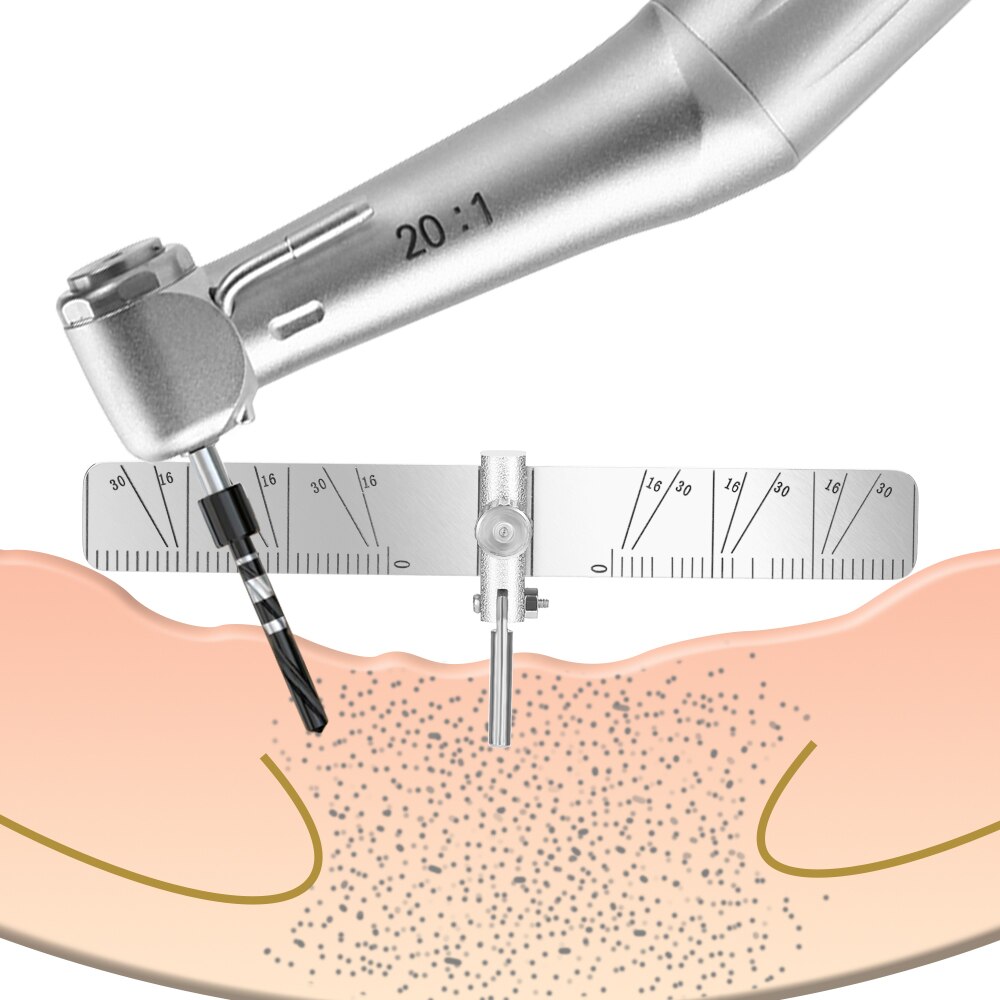 AZDENT-Guía de localización de implantes dentales, regla de posicionamiento de plantación quirúrgica, localizador, regla de ángulo de posicionamiento para dentistas, medidor de odontología