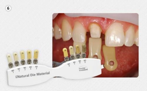 1Kit IPS Natural Die Shade Guide Dental Color Veneer Ivoclar Vivadent ND1-9 Abutment Original