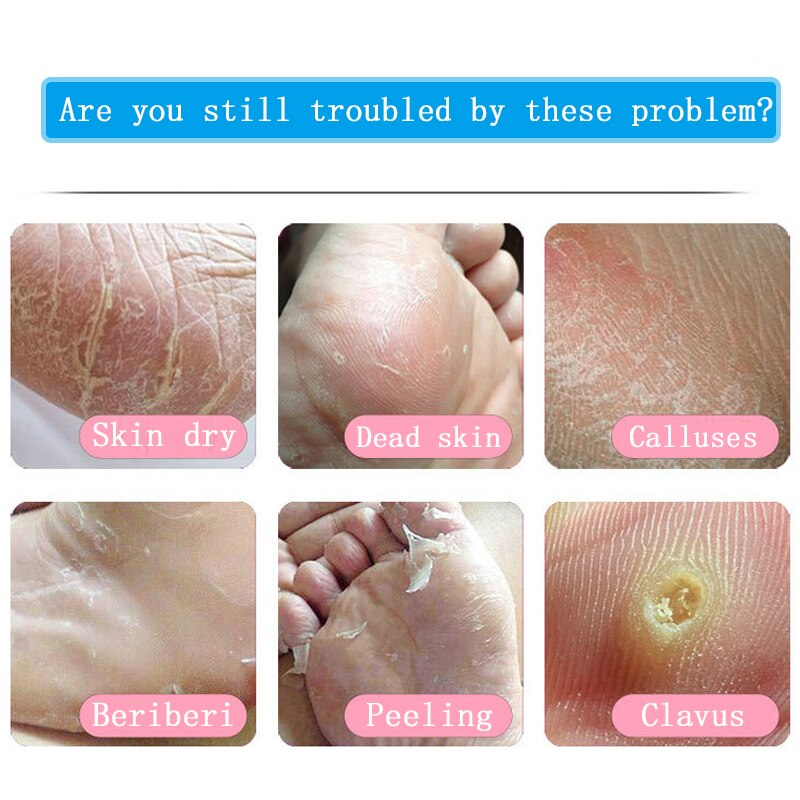 Stainless Dead Skin Pedicure Foot-Rasp File Replace Sanding-Cloth Files For Pedicure Feet-Care Remover Metal-Handle Fedicure