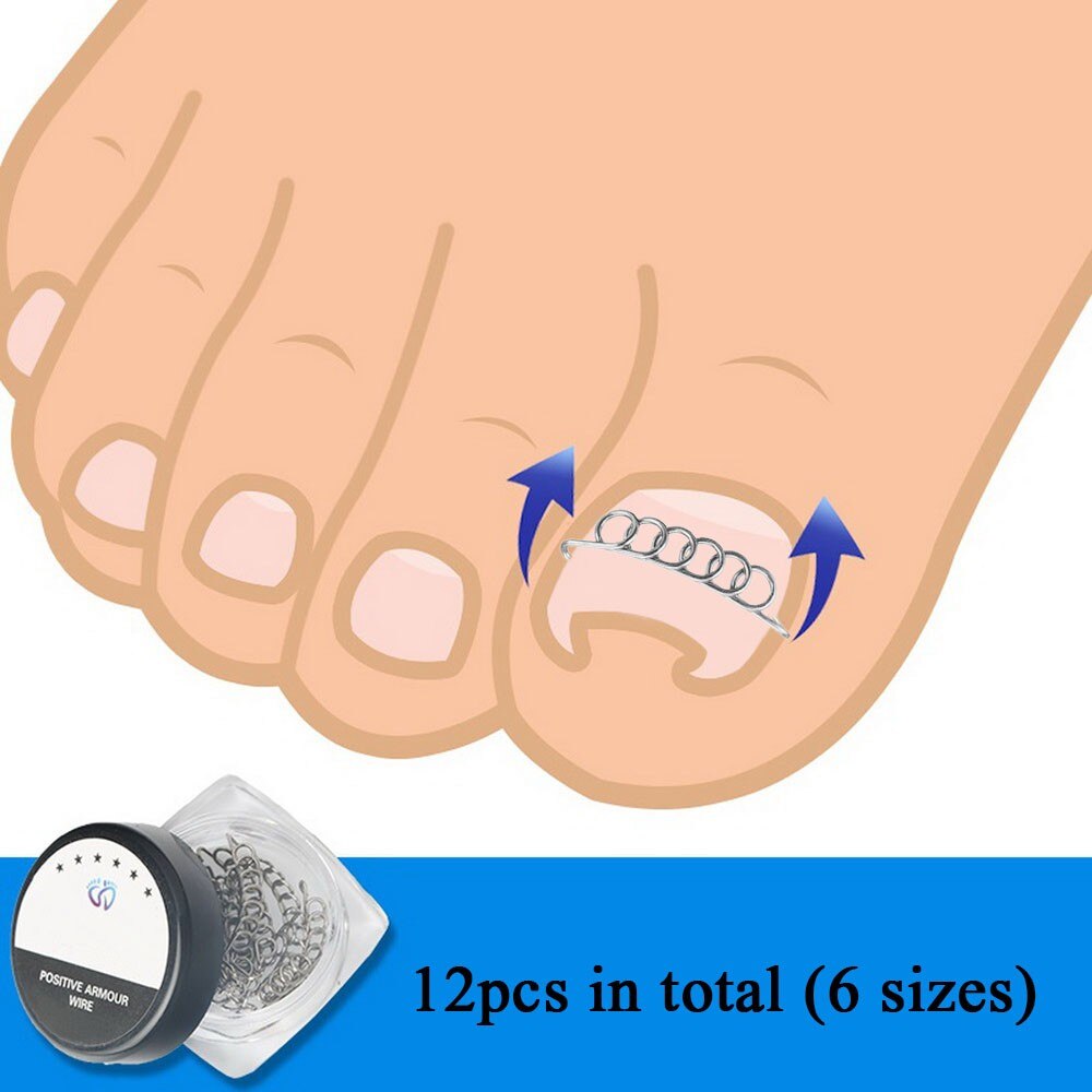12Pcs/Box Ingrown Toenail Correction Wire Fixer Grandado