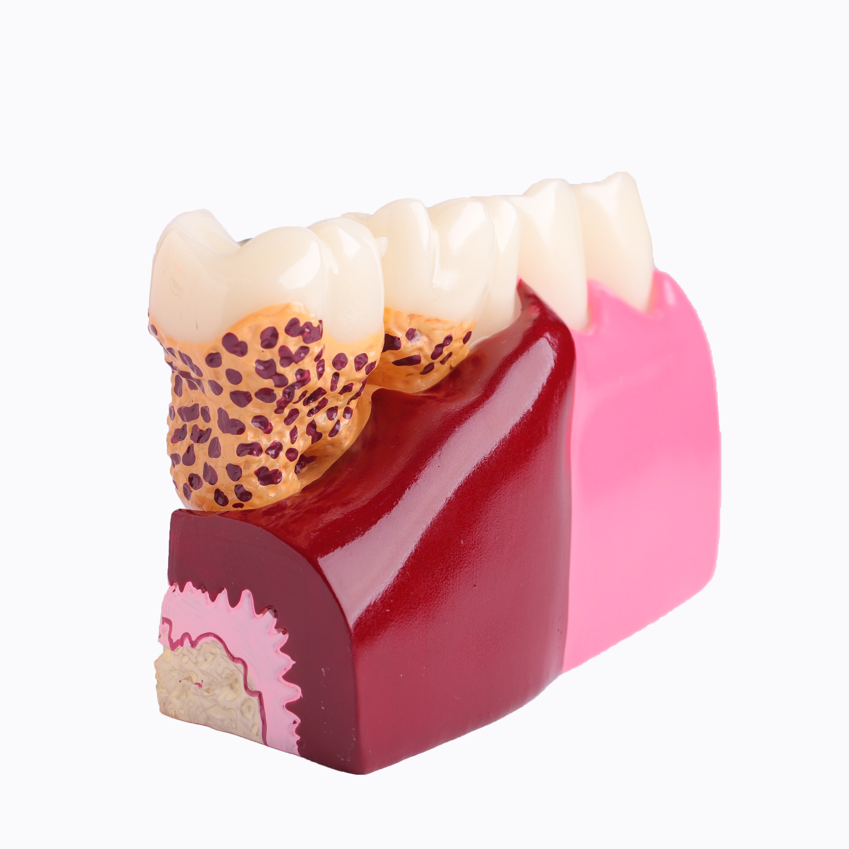 Dental Anatomy of Dental Caries Teeth Model Demonstration M4029 Planting Pathological Display Model