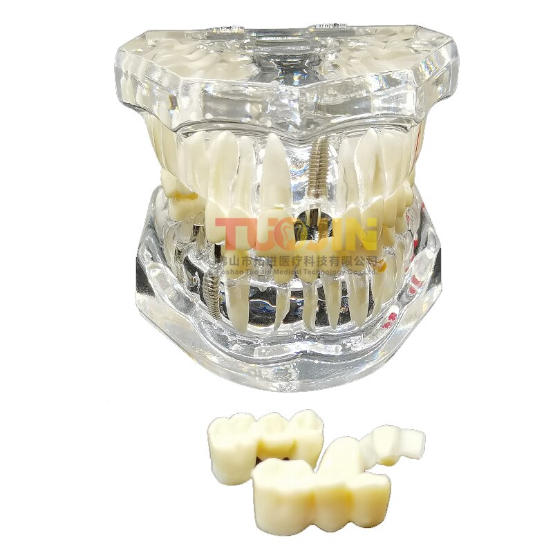 Dental Harz Zähne Tipodont Modell Für Dental Techniker Praxis Lehre Gum Zähne Kiefer Modell Zahnmedizin Ausrüstung