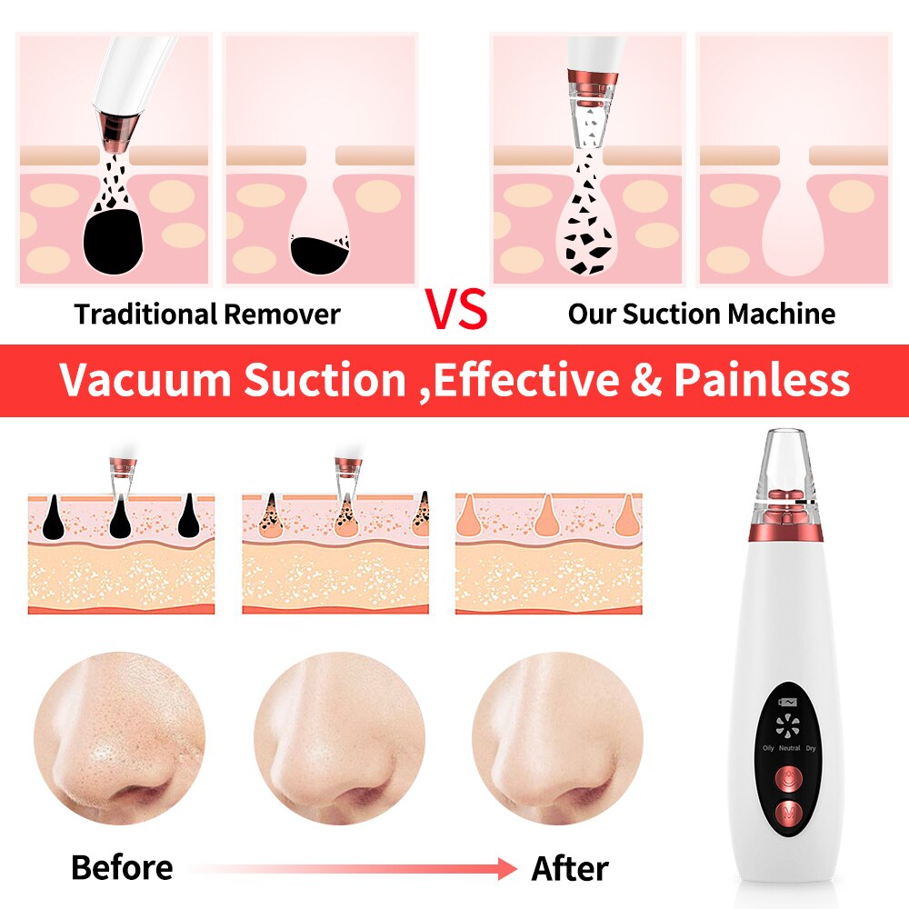 Nettoyeur de points noirs pour le visage, outil de nettoyage profond du nez, Zone T, élimination des pores, des boutons d'acné, aspiration sous vide, diamant, beauté du visage, nettoyage de la peau