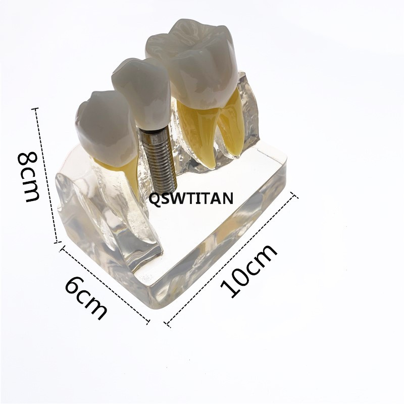 Clear Dental Demonstration Study Teeth Model for Implant Analysis Crown Bridge Model