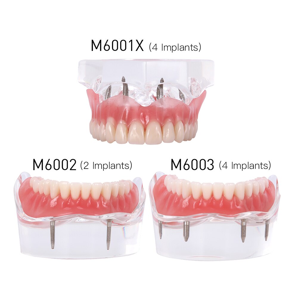 Dental Implant Teeth Model Removable Interior Mandibular Demo Overdenture With Implants upper/Lower for Tooth Teaching Study