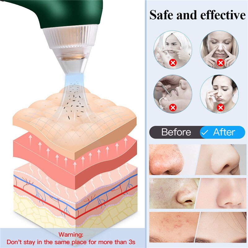 Ckeyin-microscopio eliminador de espinillas, limpiador de poros al vacío, succión de compresa , eliminación de manchas negras, limpieza facial eléctrica, 20X
