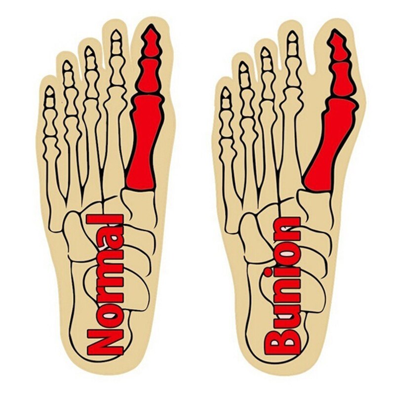 droppshipin 1 Pair Great Toe Cyst Foot Care Tool Stretch Nylon Hallux Valgus Guard Cushion Bunion Toes Separator Thumb Protector MFJ99