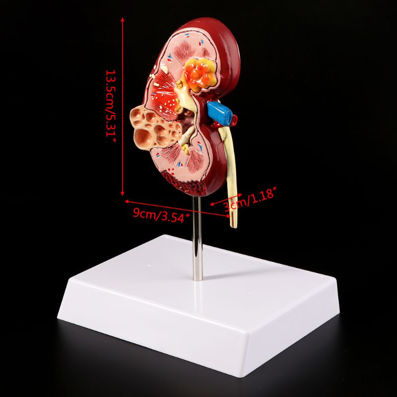 Life Size Human Kidney Diseased Model Anatomical Anatomy Diseased Pathological Stone Organ Teaching Supplies D5QC