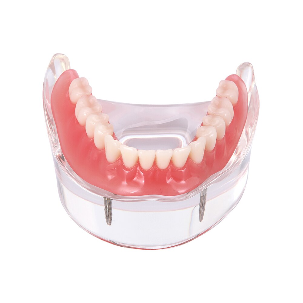 Dental Implant Teeth Model Removable Interior Mandibular Demo Overdenture With Implants upper/Lower for Tooth Teaching Study: Lower - 2 Implants