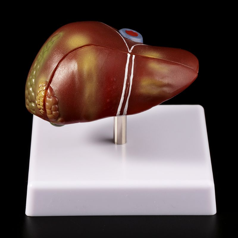 Modelo anatómico patológico del hígado humano, herramienta de exhibición para enseñanza escolar de anatomía, equipo de laboratorio L29K