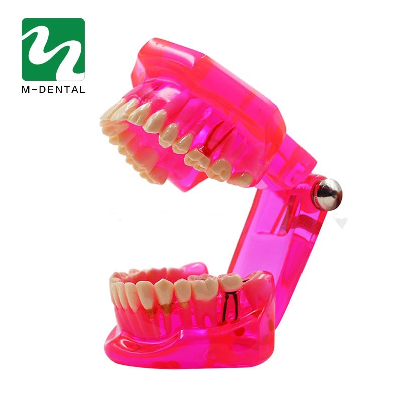 Modelo de dientes de estudio Dental desmontable para adultos, modelo de dientes de enseñanza patológica, rojo transparente, 1 unidad
