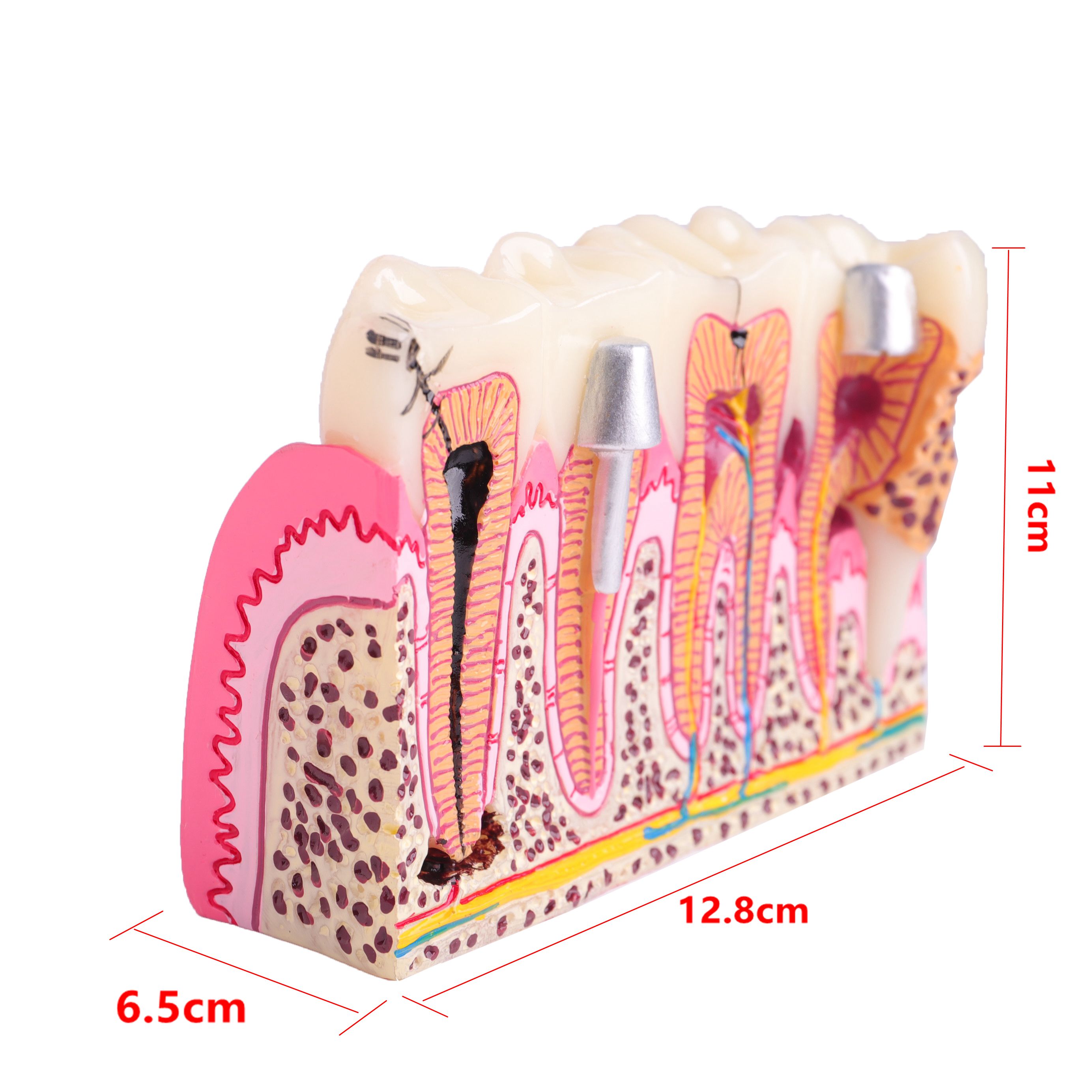 Dental Anatomy of Dental Caries Teeth Model Demonstration M4029 Planting Pathological Display Model