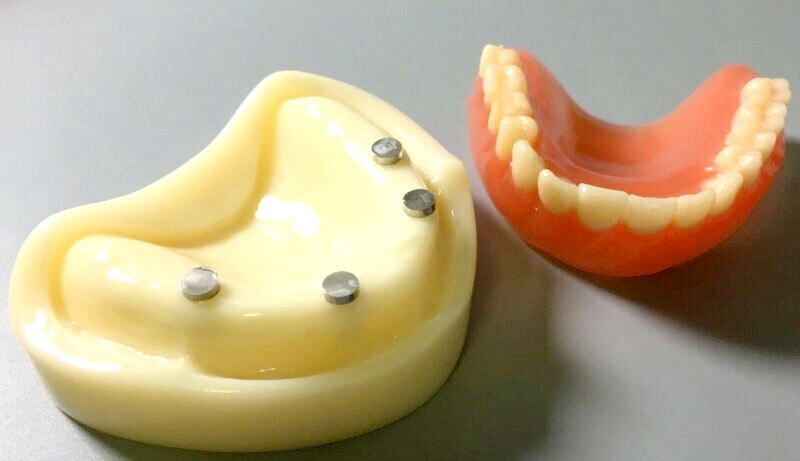 Modelo de dentadura completa Dental, accesorio magnético, estudio superior de la Mandibular