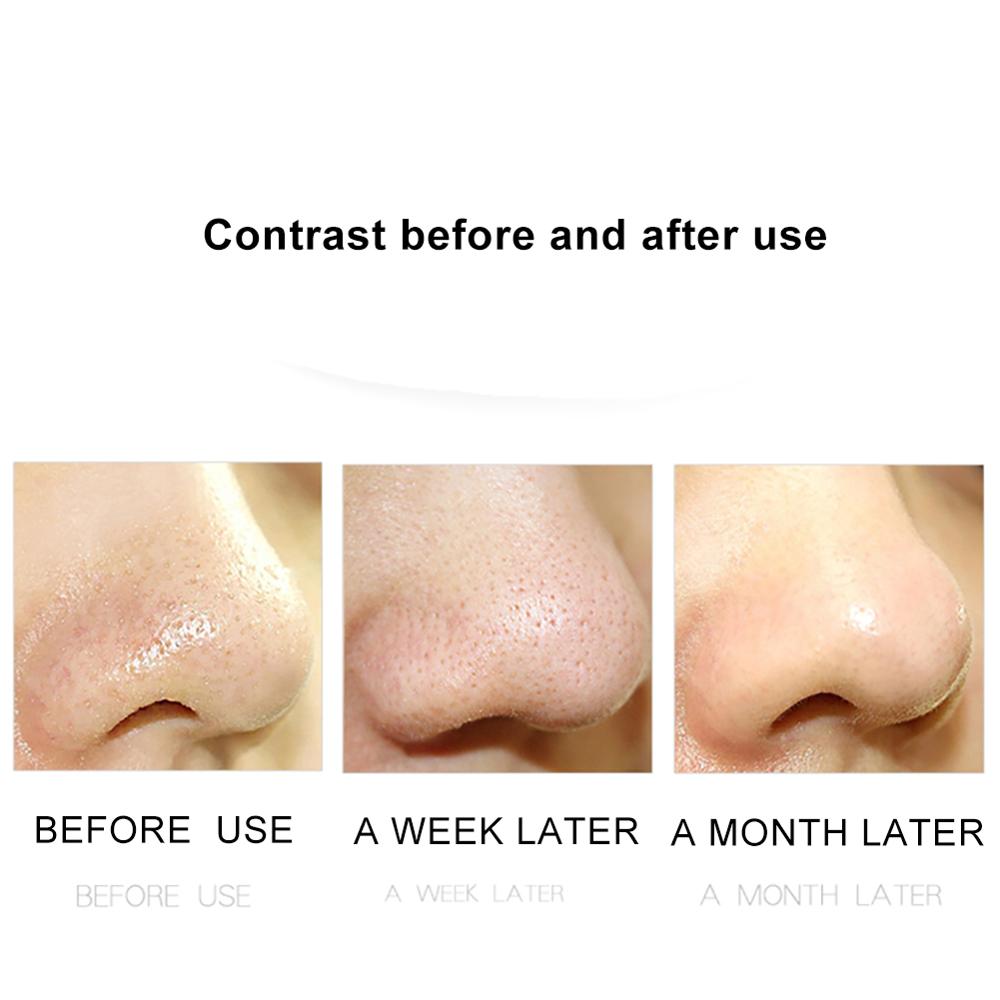 Ultrasonic Skin Scrubber Face Spatula Blackhead Removal Pore Cleanser Skin Peeling Lifting Comedone Extractor Beauty Instrument