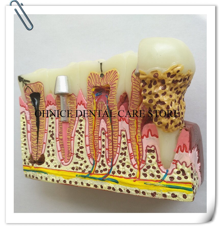 Dental Pathologies Model M4029 showing caries and apical lesion conditions/Dental Study tooth model Doctor-patient communication