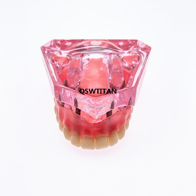 Sobredentadura Dental Superior con 4 implantes, modelo de demostración, enseñanza Dental, estudio, modelo de dientes: Pink 4 Implants