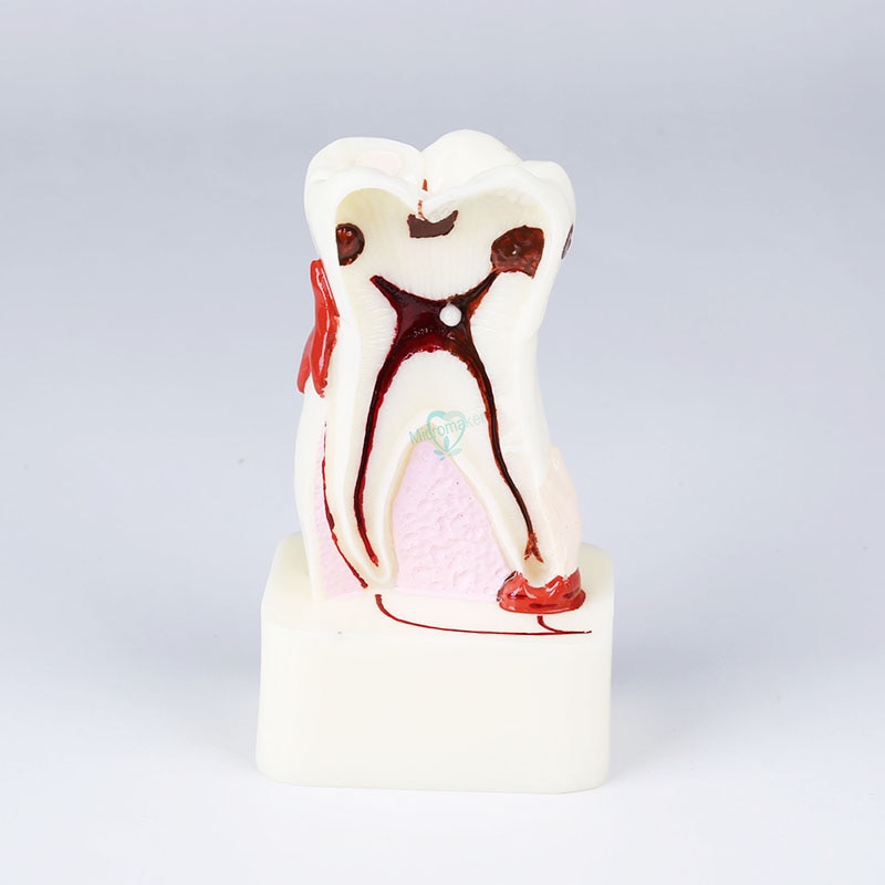 1 pièces dentiste étude dentaire enseignement modèle de dent 4 modèles de maladie des dents
