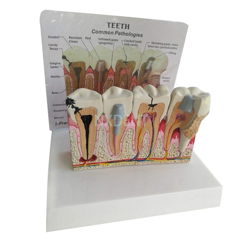 1 Stuks Dental Anatomische Tand Tanden Model Anatomie Tanden Model Oversized Anatomie Rotte Tand Demonstratie Communicatie