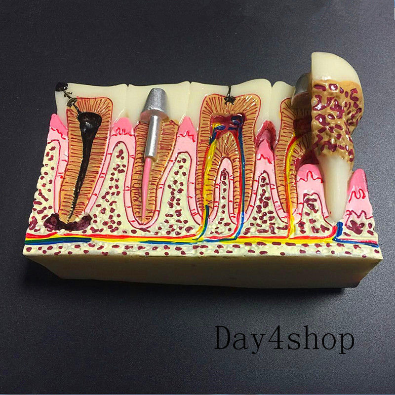 Tandheelkundige Anatomie Van Cariës Plastic Tanden Model Demonstratie Communicatie