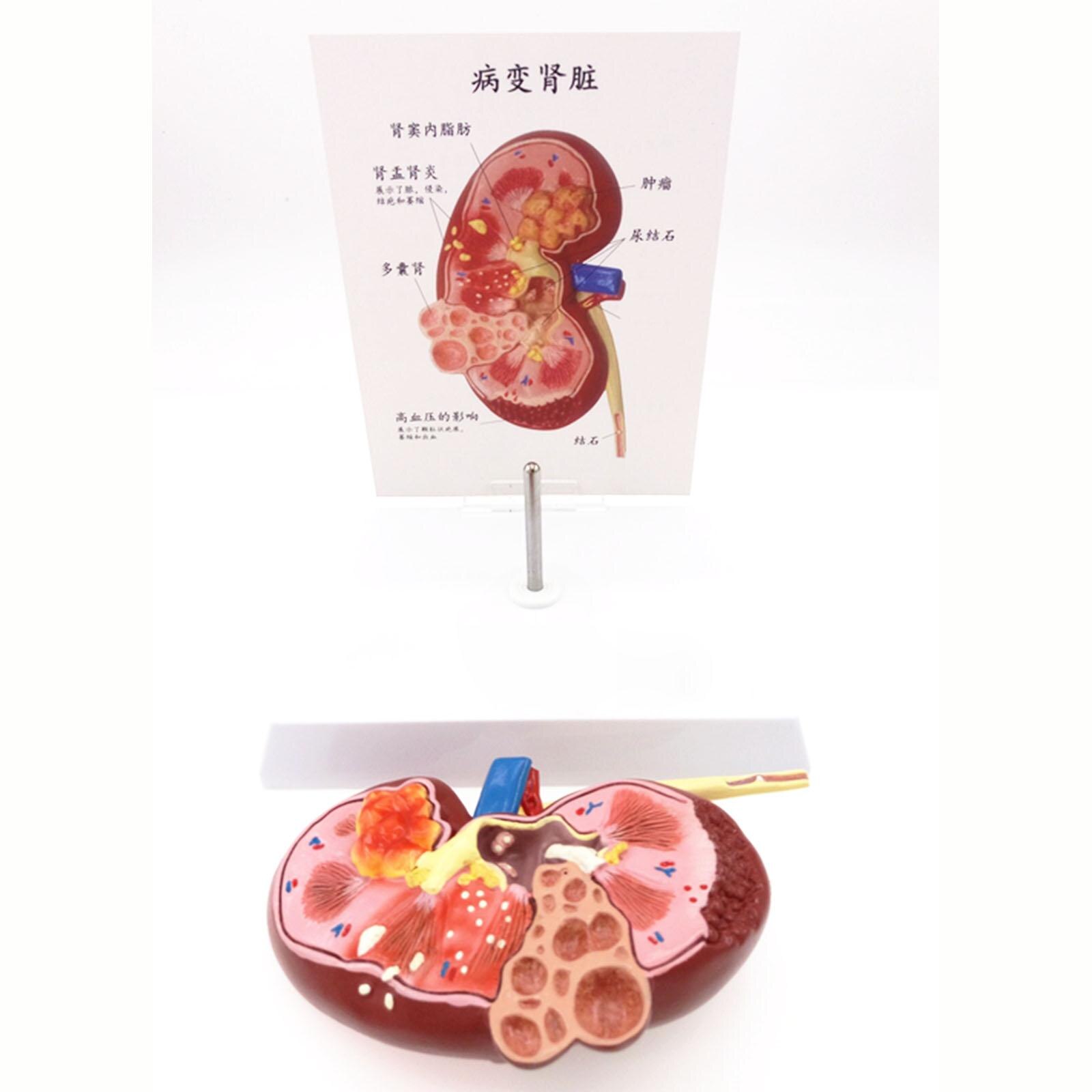 Zieke Nier Model Human Anatomisch Medische Pathologische Veranderingen Specimen Voor Patiënt Onderwijs Onderwijs Middelen
