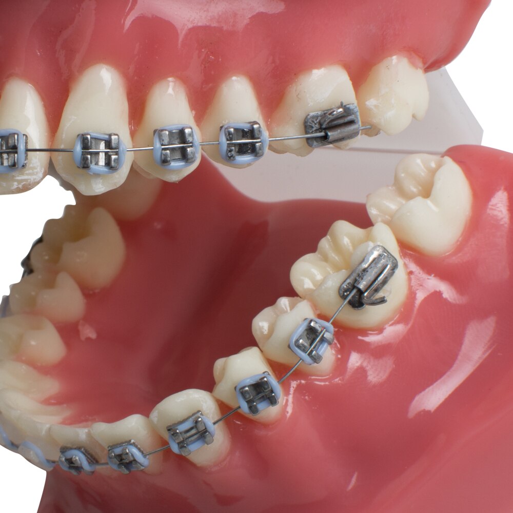 Dental Tanden Studie Orthodontische Rode Model met Metalen en Keramische Brackets Orale Demonstreren Modellen
