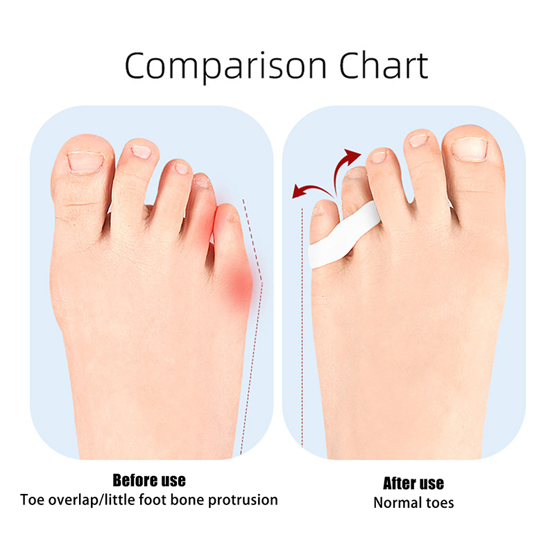1 para palucha koślawego silikonowy korektor żel pielęgnacja stóp Separator palców u stóp mały palec Protector prostownica do haluksów Pedicure