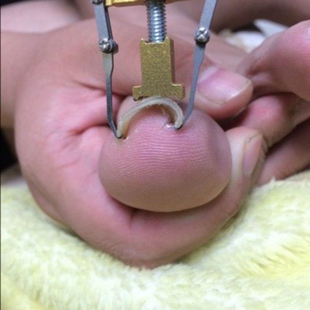 Outil de Correction d'ongles incarnés, tondeuse de manucure et pédicure, récupération Pro, soins des pieds, correcteur orthopédique d'oignon des ongles