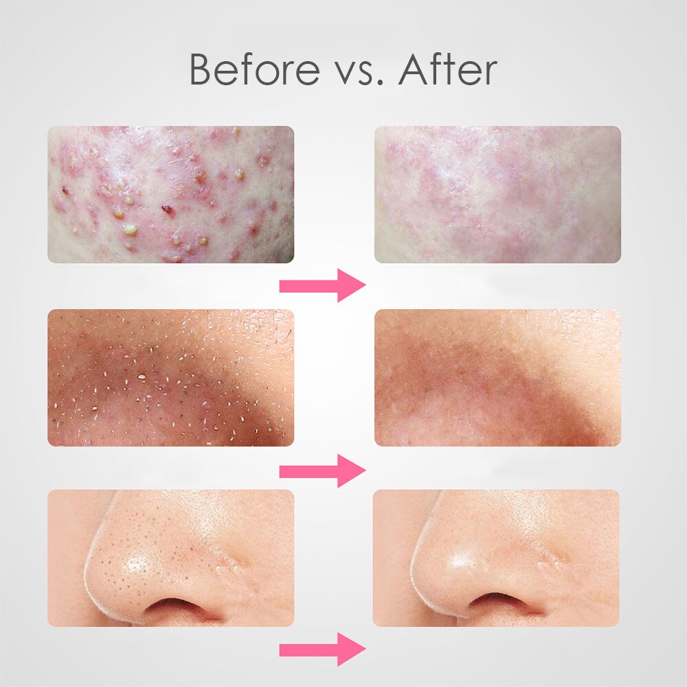 7PCS Black Dots Extractor de cravo Acne Black Spots Remover Blackhead Comedone Removal Needles Clip Tweezer Set Face Skin Care