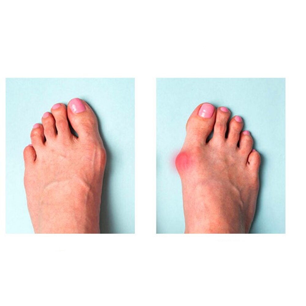 1Pair Ring Tail Finger Toe Separator Silicone Gel Bunion Hallux Valgus Overlapped Pain Relief Finger Toe Corrector Foot Care Too