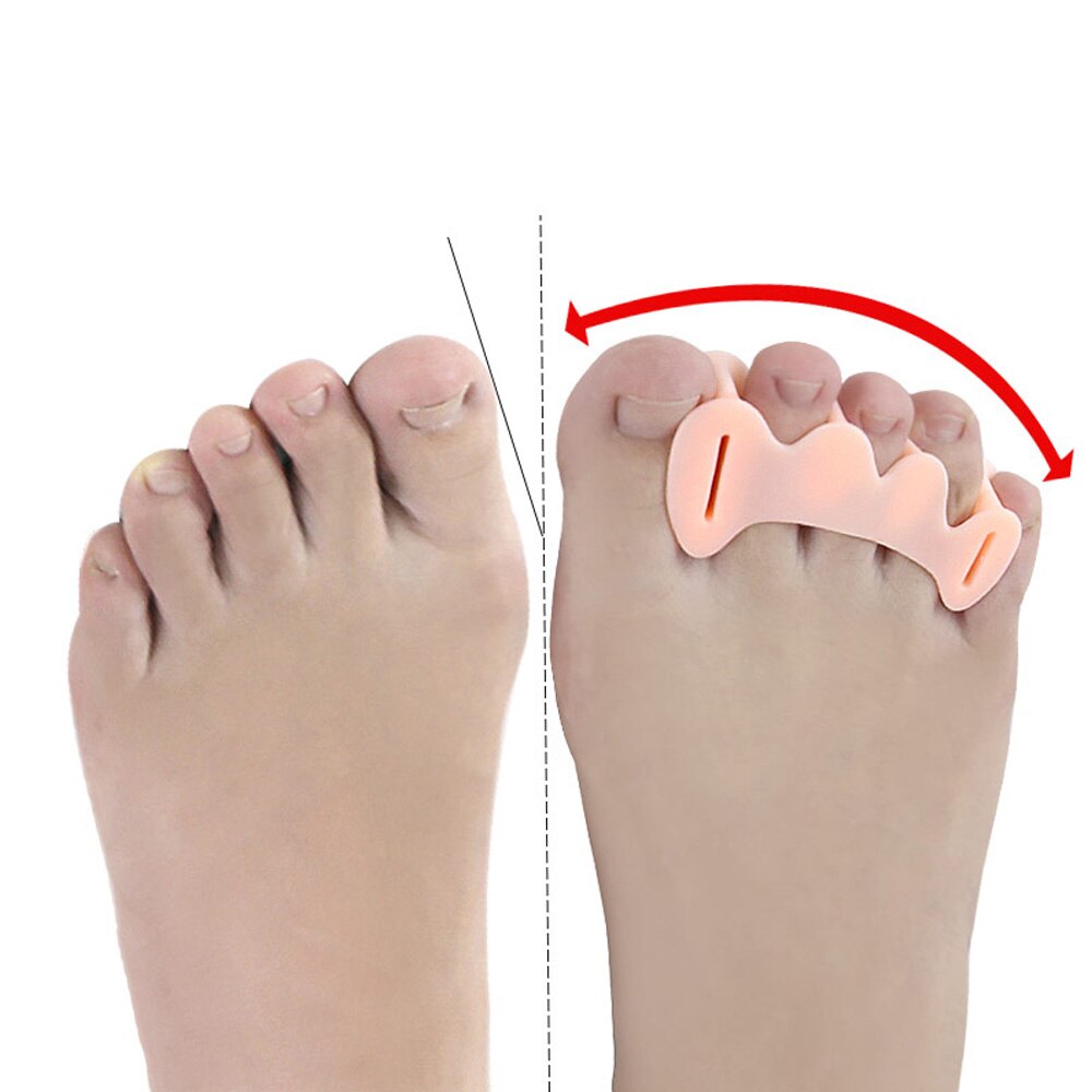 Tcare 1 par knyst korrigerer aflastningsbeskytter knyst tå glattejern naturlig behandling smerte hallux valgus tæer led tå separatorer