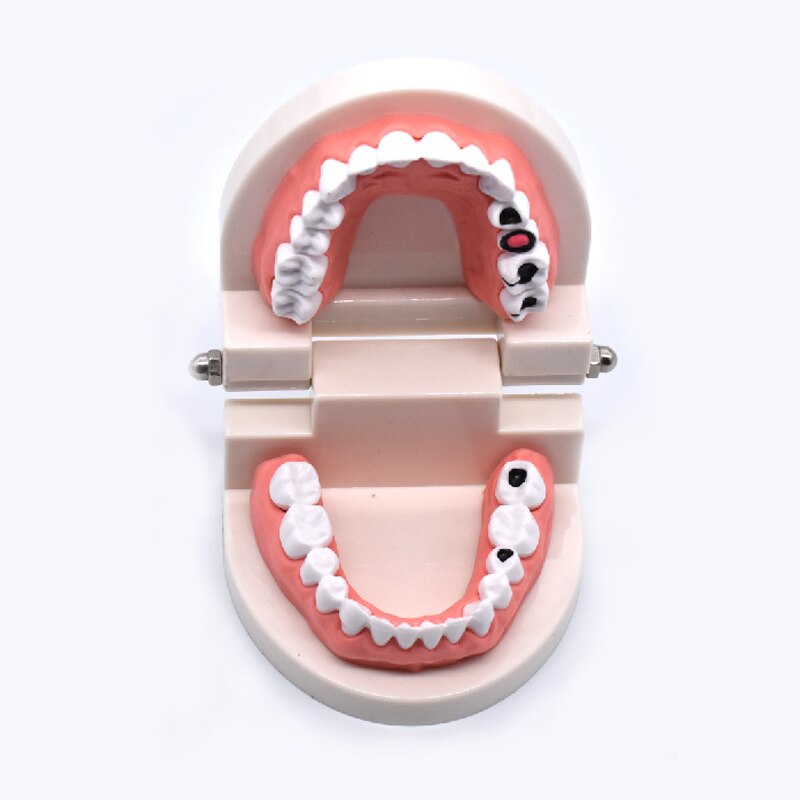 Dental Studie Onderwijs Tanden Model Rotte Tand Verval Cariës Tand Zorg Onderwijs Tandarts Apparatuur Prothese