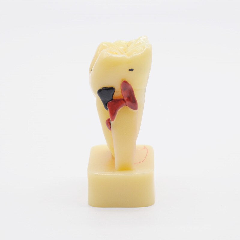 1pc Teeth Model 4 Times Tooth Pathology Model Comprehensive Periodontal Models for Dental Teaching Study Model