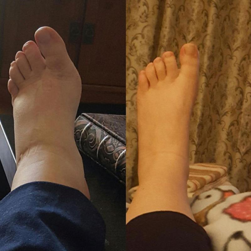 Women Compression Stockings Pressure Varicose Vein Stocking knee high Leg Support Stretch Pressure Men Circulation Stocking