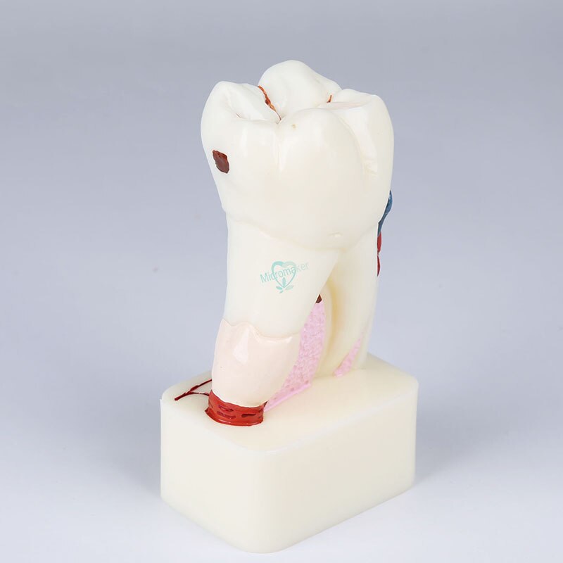 1 pièces dentiste étude dentaire enseignement modèle de dent 4 modèles de maladie des dents