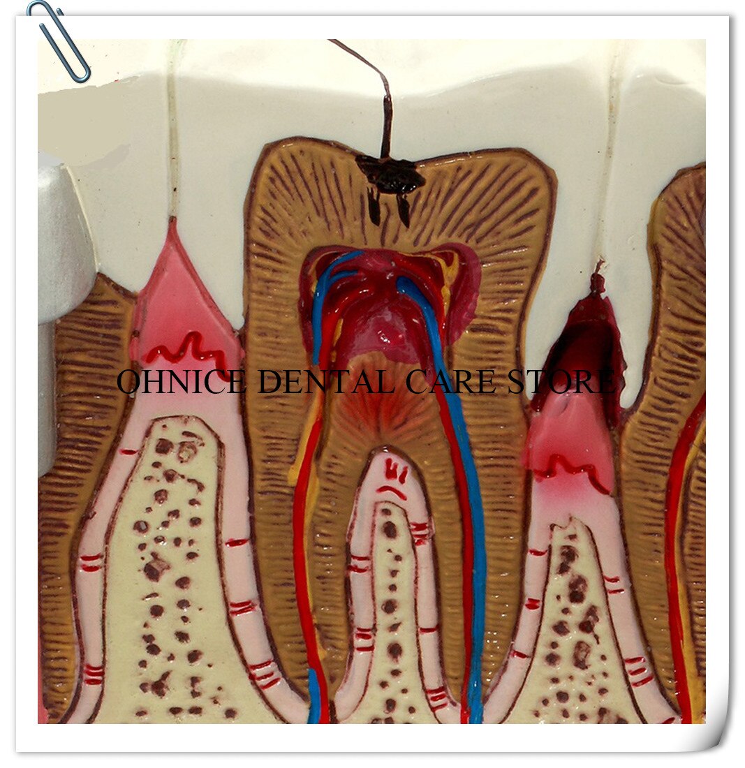 Dental Pathologies Model M4029 showing caries and apical lesion conditions/Dental Study tooth model Doctor-patient communication