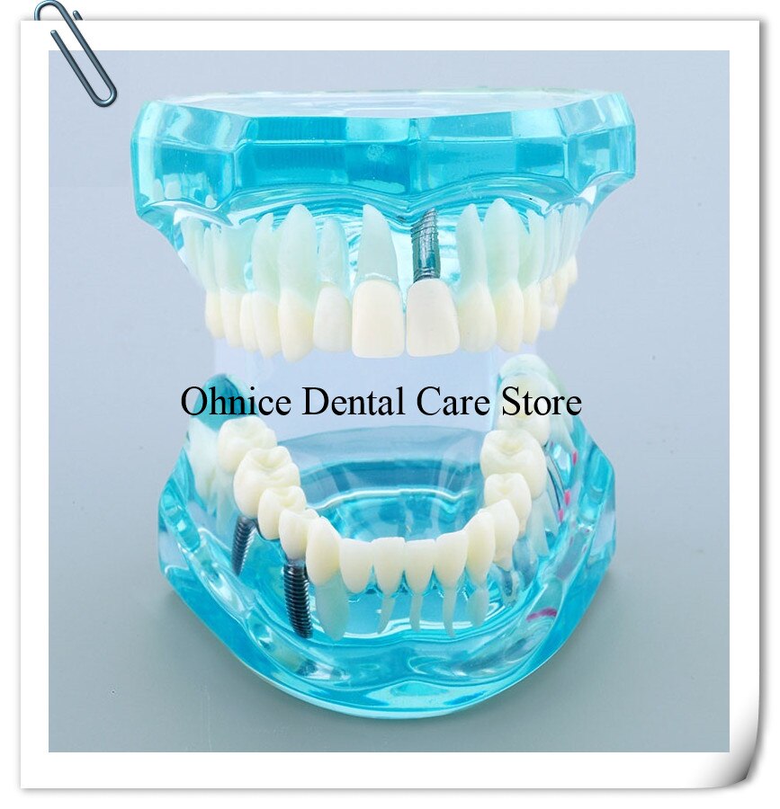 Dental Implantat Restaurierung zähne Modell M2001 Dental lehre zahn modell/Dental Labor Klinik zähne modell