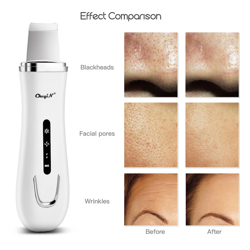 Ultra Sonic Facial Skin Scrubber Elektrische Sonic Trillingen Gezicht Schoner Dode Huid Mee-eter Verwijderen Schop Comedo Extractor
