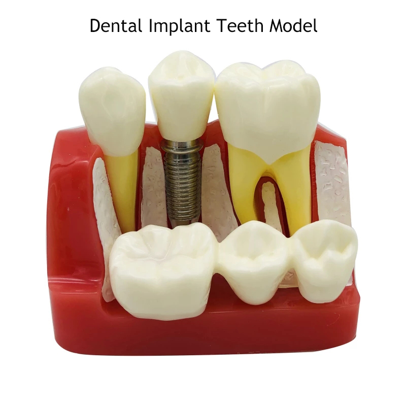 1Pcs Dental Tooth Implant Removable Model Crown Abutment Dentistry Laboratory Educational Materials Dentist Study Dentures M2017