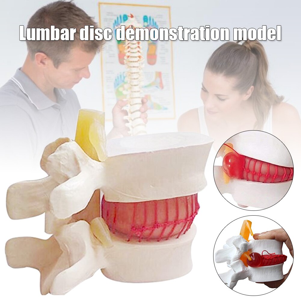 1pc Anatomical Lumbar Disc Herniation Lumbar Spine Model White Color J99Store