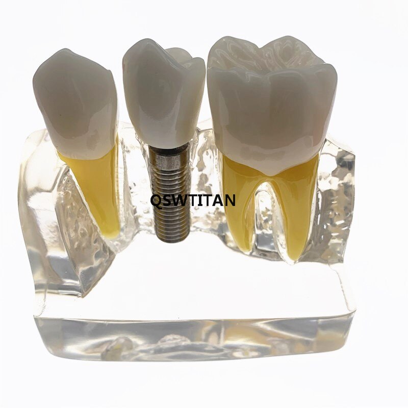 Clear Dental Demonstration Study Teeth Model for Implant Analysis Crown Bridge Model