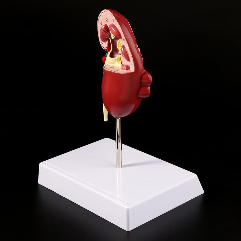 Life Size Human Kidney Diseased Model Anatomical Anatomy Diseased Pathological Stone Organ Teaching Supplies D5QC