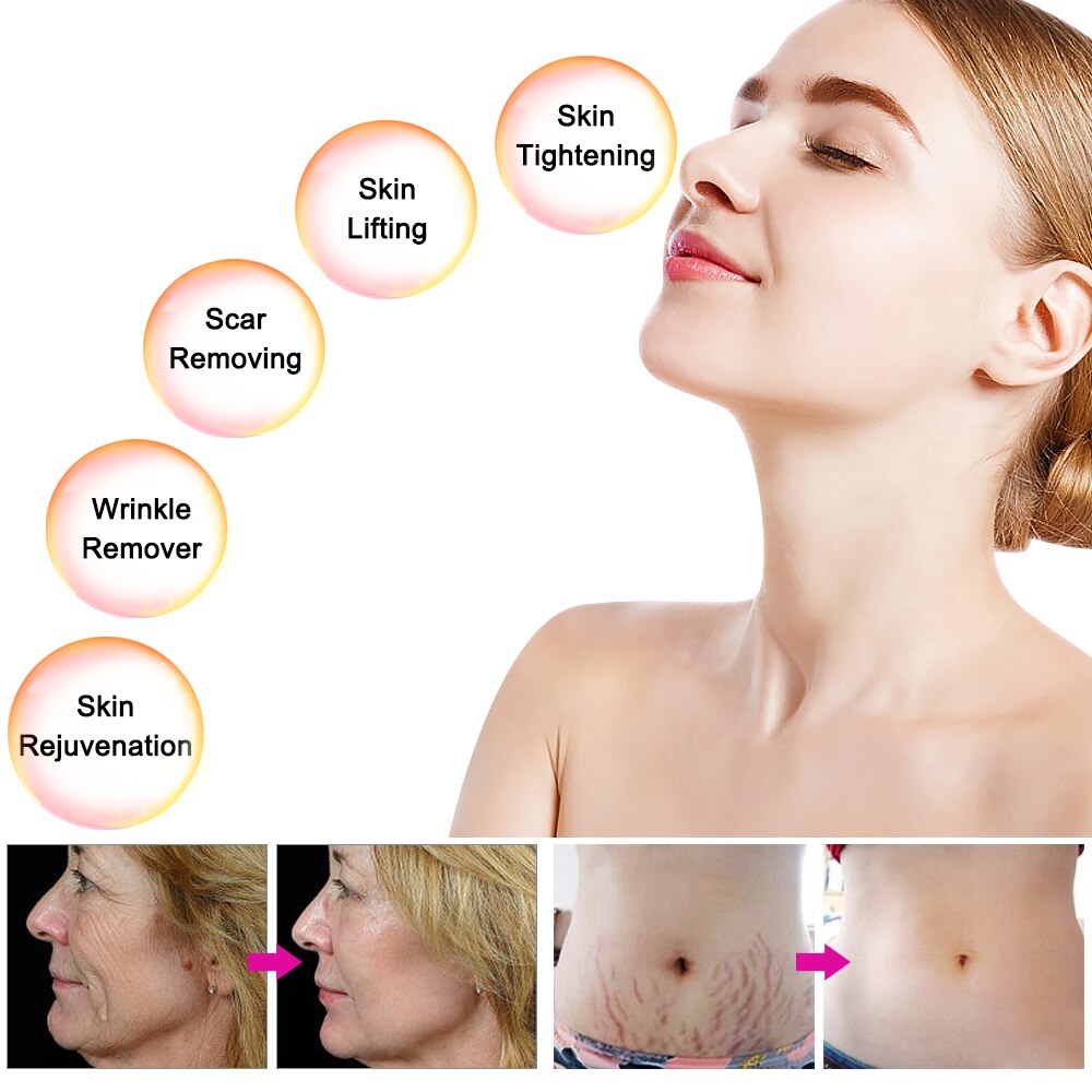 Strongest Fractional RF Micro-Needling Machine and Body RF Micro-Needling Beauty Equipment Skin Care Machine CE