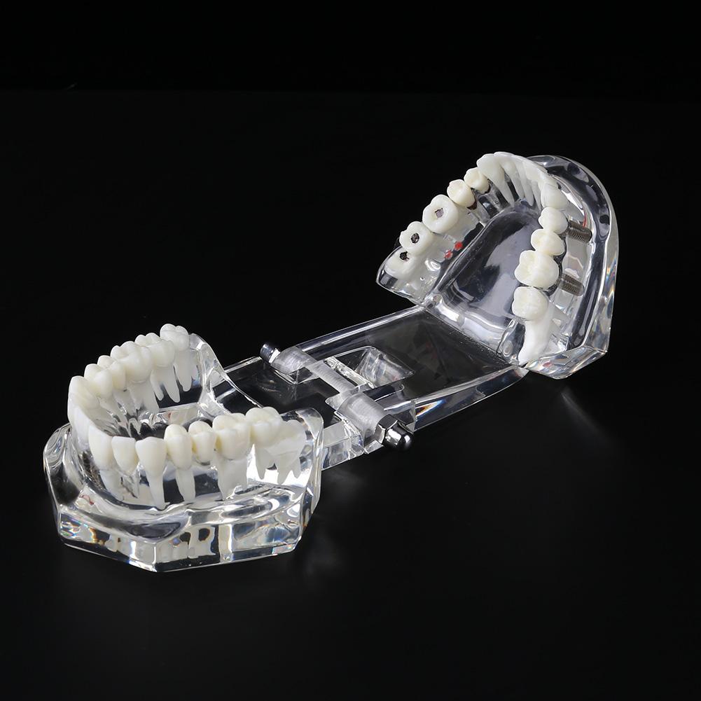 Dental Implant Ziekte Tanden Model Met Restauratie Brug Tand Tandarts Voor Medische Wetenschap Tandheelkundige Ziekte Onderwijs Studie