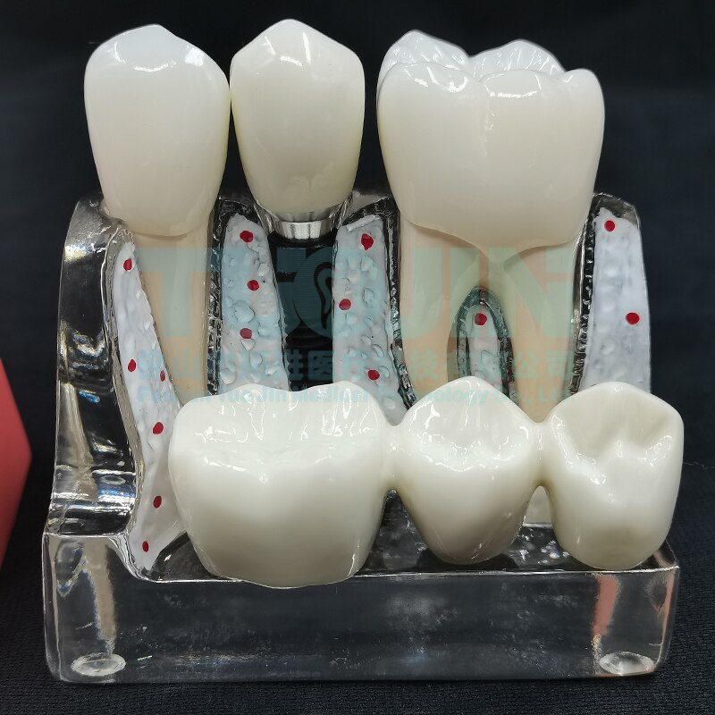 Dental Harz Zähne Tipodont Modell Für Dental Techniker Praxis Lehre Gum Zähne Kiefer Modell Zahnmedizin Ausrüstung: TYPE 4