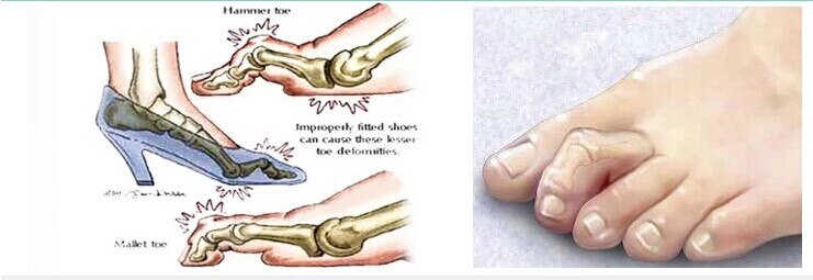 1Pair Unisex Hammer Silicone Toe Protection Bone Toe Ectropion Corrector Health Care Product File For Feet Valgus Adjuster -15