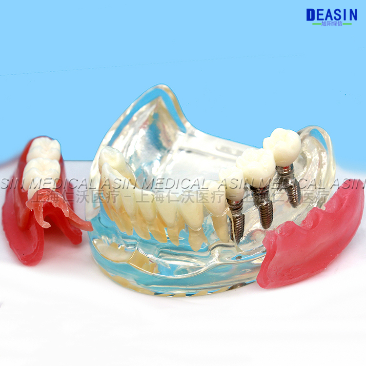 1 pc x Resin Coverage dental implant model dentures Removable teeth model for dentist study Deasin