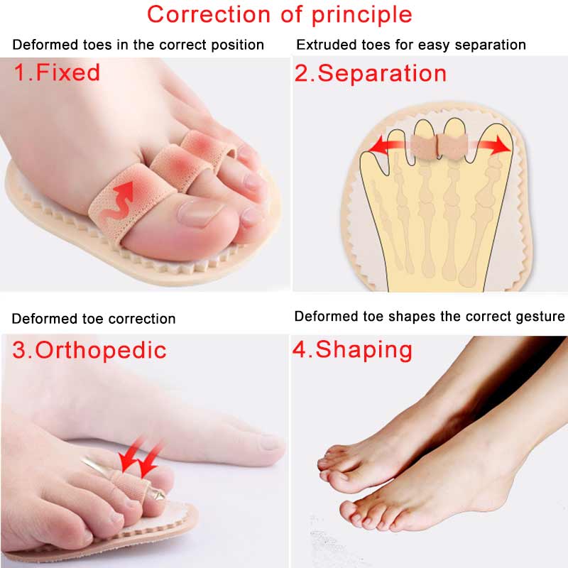 1 Pair Hammer Mallet Toe Separator Hallux Valgus Orthopedic Pads Orthotics Bending Deformation Overlap Foot Toe Correction Socks