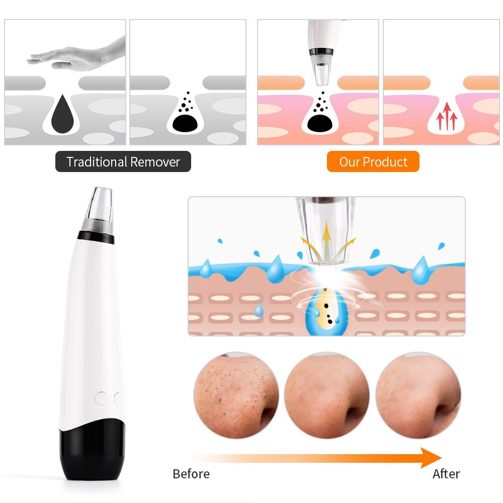 Eliminador de espinillas por succión al vacío, Extractor de puntos negros y acné por USB, máquina para el cuidado de la piel