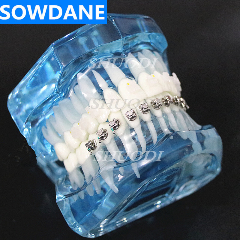 Dental Orthodontic Model with Ceramic and Self-Ligating Metal Brackets for Patient Communication