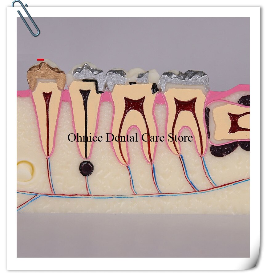 Periodontal disease teeth model M4009/dental teaching model Molar cross section study teeth model